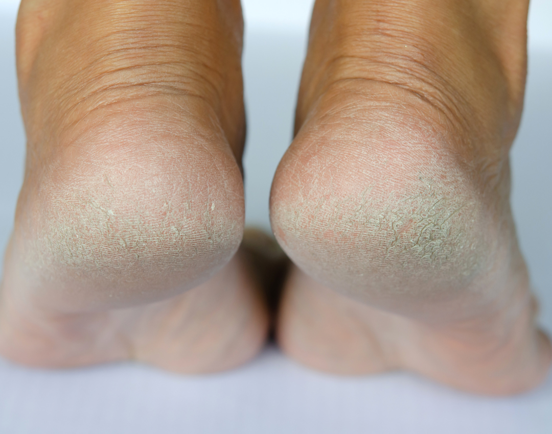 Understanding Corns And Calluses On Feet Causes Prevention And Treatment