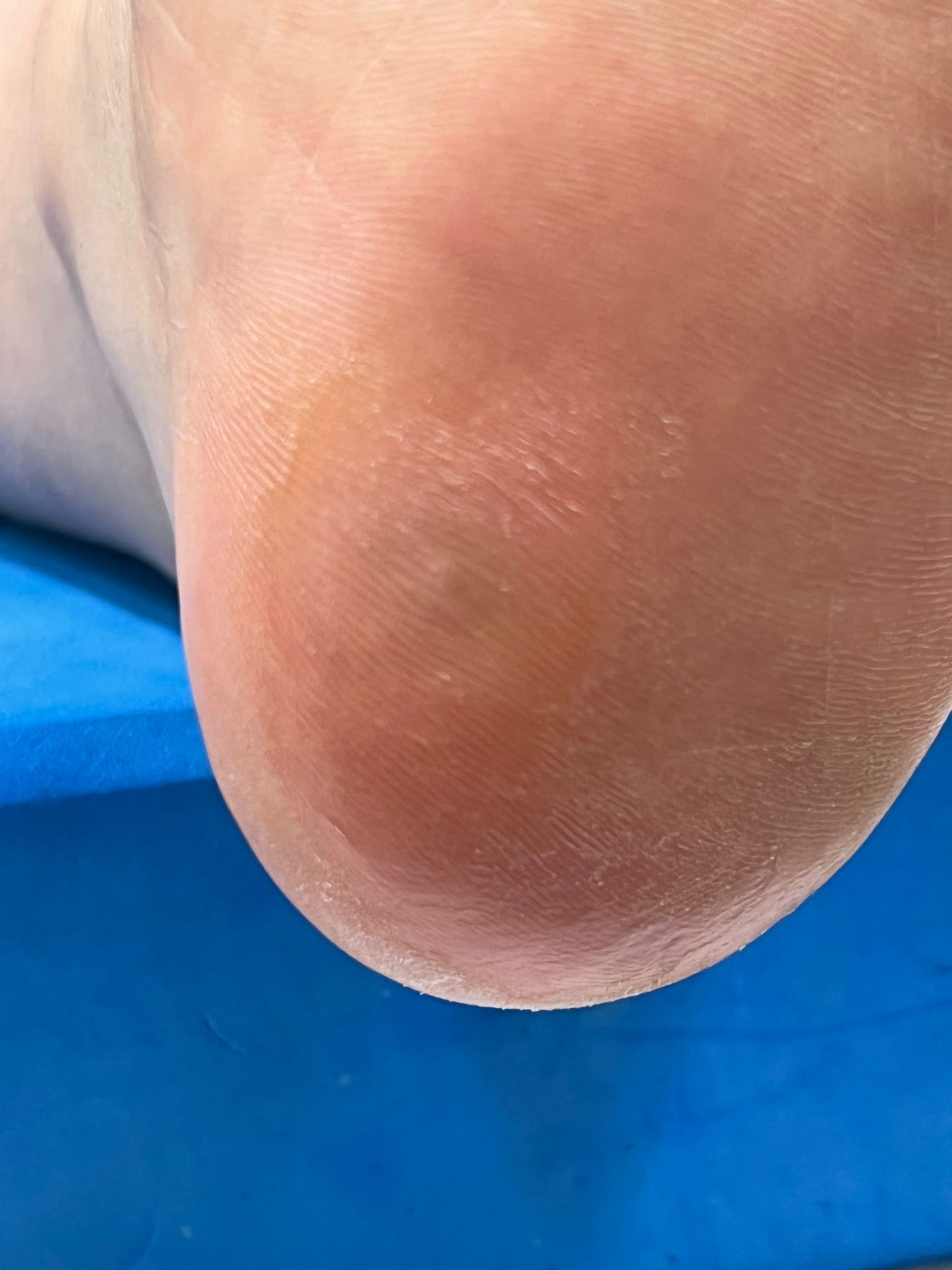 Verruca after finishing the treatment. Complete resolution