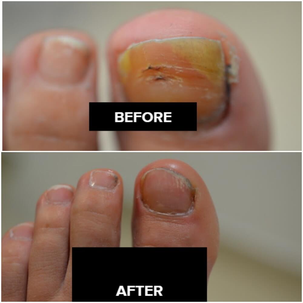 Laser Nail Fungal Treatment Toenail Fungus Removal London