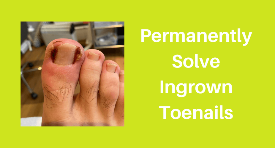 The Rise Of Ingrown Toenails