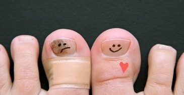 Laser Treatment For Fungal Nails