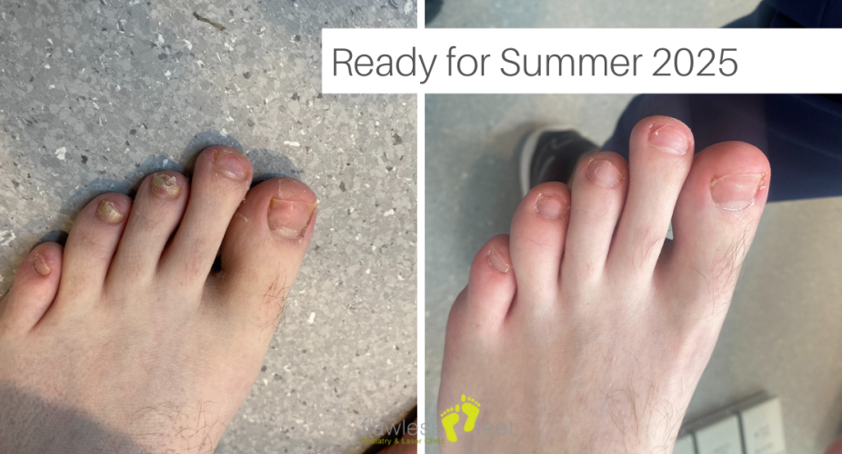 Treat Your Fungal Nails Now To Get Them Ready for Summer 2025!