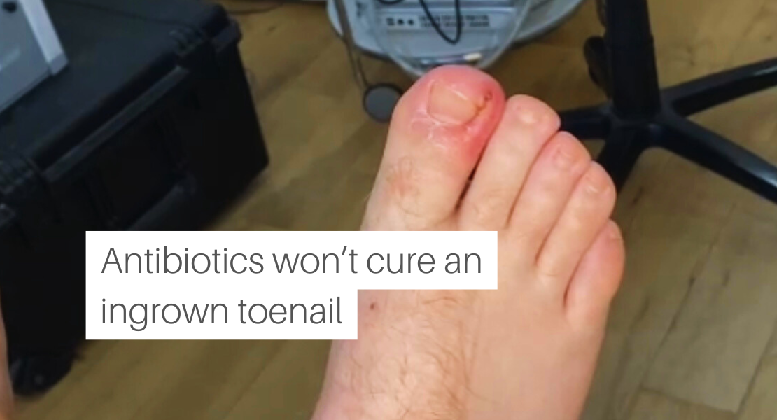 Why Antibiotics Won’t Cure An Ingrown Toenail